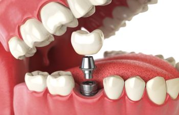 Dental Implant Elk Grove CA