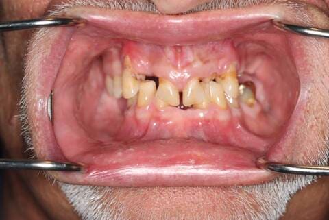 male patient after all on 4 dental implants procedure