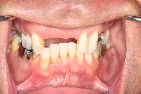 male patient before all on 4 dental implants procedure